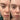 Before and after acne. 30 day blind test.